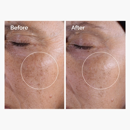 The Ordinary - Glycolic Acid 7% Exfoliating Toner - Eksfoliējošs Toniks ar 7% Glikolskābi - 100ml