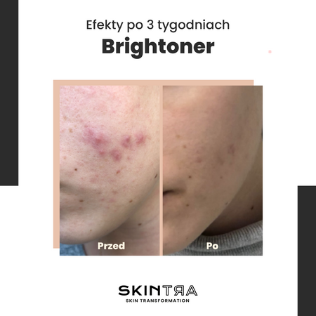 SkinTra - Brightoner - Visa Gada Skābju Toniks 9% - 100ml